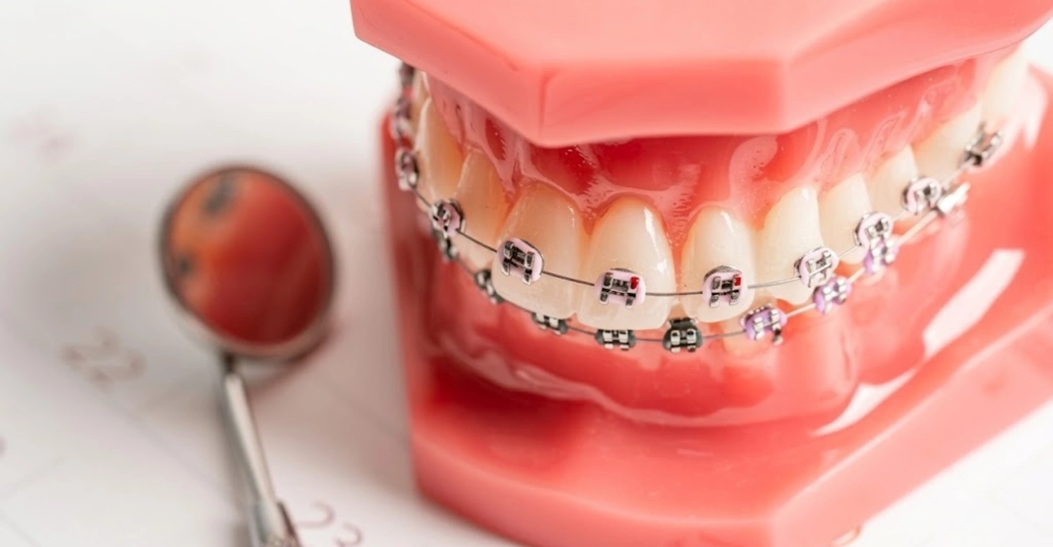 Thalassemia orthodontic treatment1